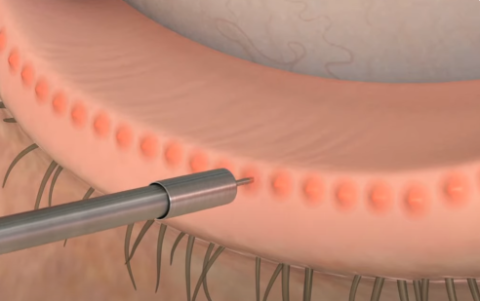 Meibomian Gland Probing Dry Eyes Clinic