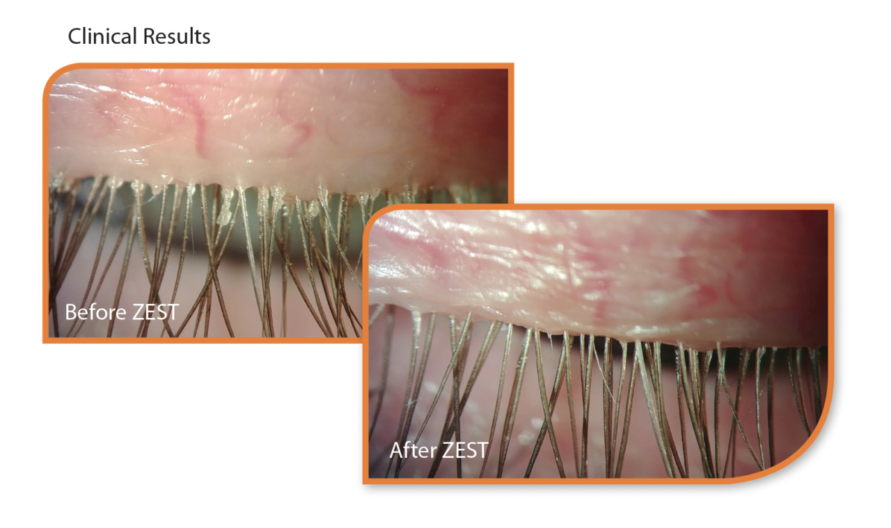 Introducing Zest Blepharitis And Dry Eye Treatment Dry Eyes Clinic