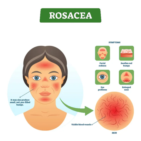 Rosacea - Dry Eyes Clinic