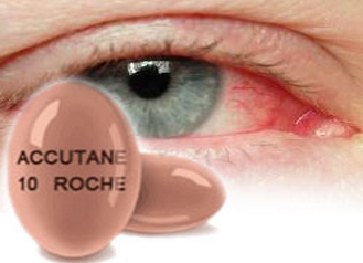 Effects of Roaccutane on Eyes