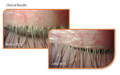 Introducing ZEST® Blepharitis and Dry Eye Treatment