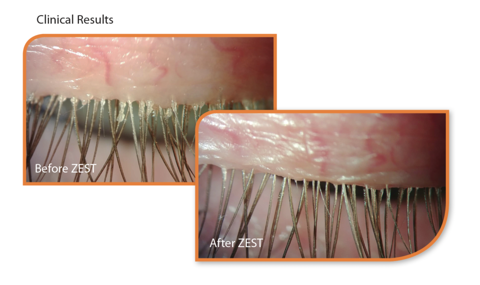 Introducing Zest Blepharitis And Dry Eye Treatment Dry Eyes Clinic