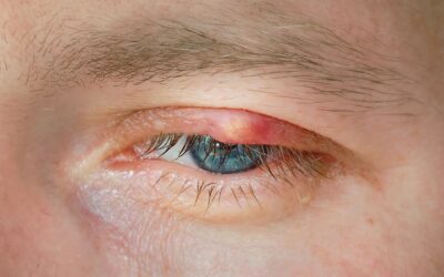 What is a Chalazion?